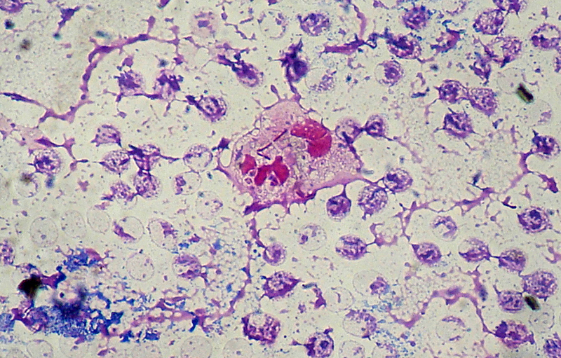 Bacteria Pseudomonas aeruginosa infectando el torrente sanguíneo. Foto: Wikipedia